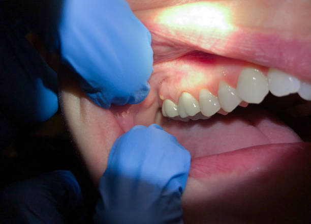 Best Emergency Broken Tooth Repair in La Crescent, MN